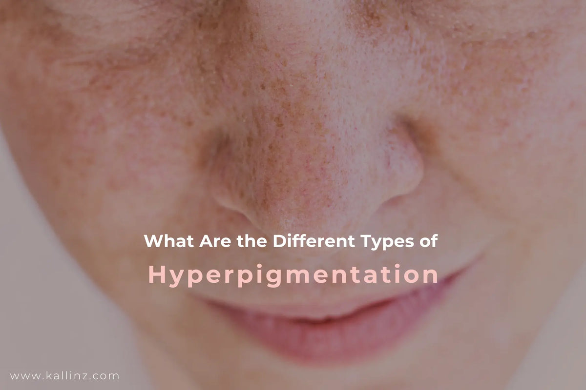 Hyperpigmentation Xample What Are the Different Types of Hyperpigmentation – Kallinz