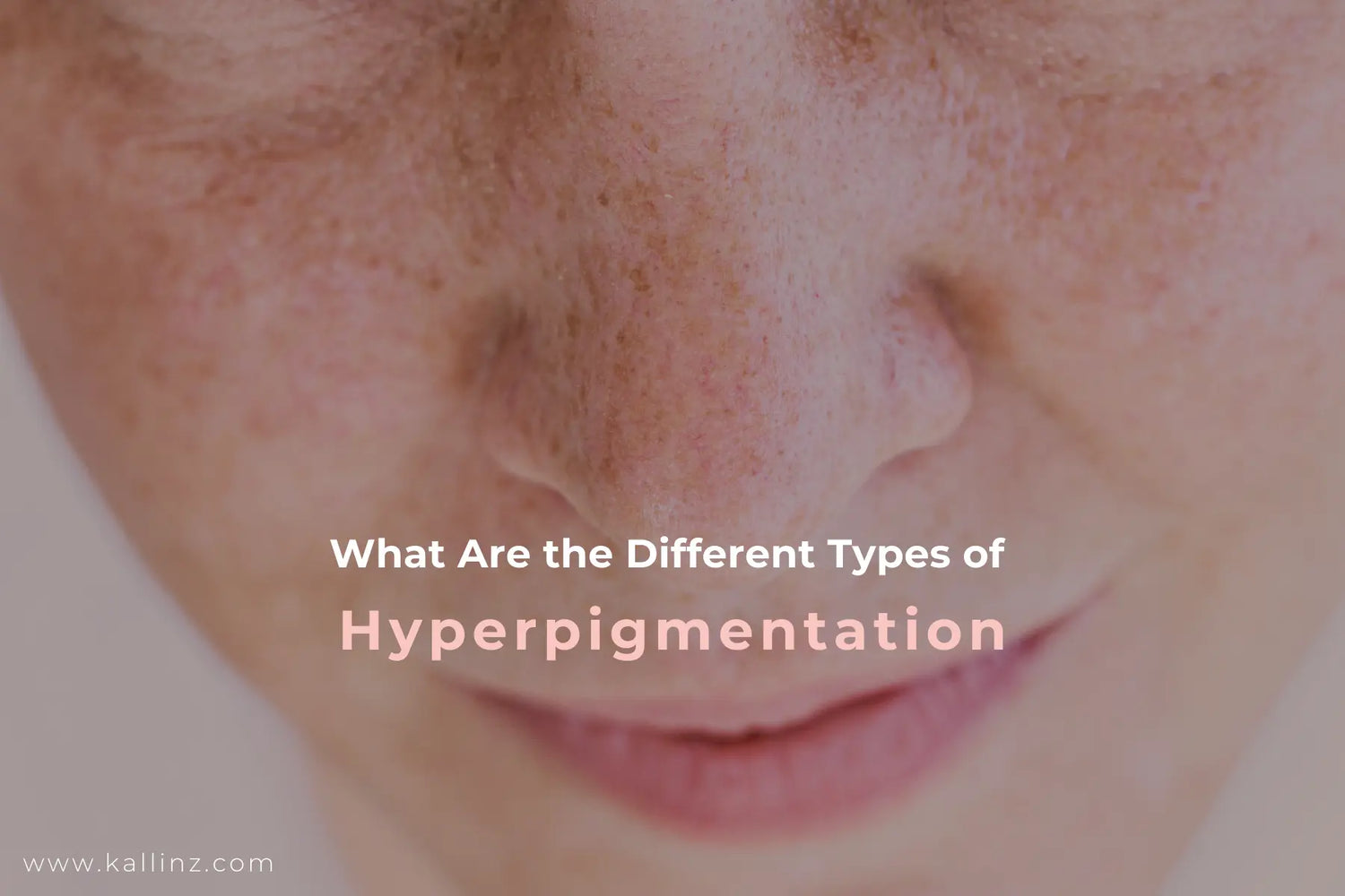 Common types of Hyperpigmentation Blog Cover